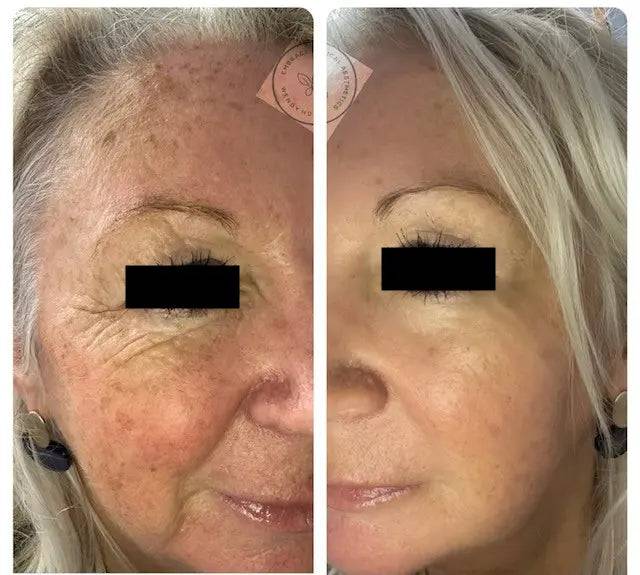 CALECIM Professional Serum CALECIM