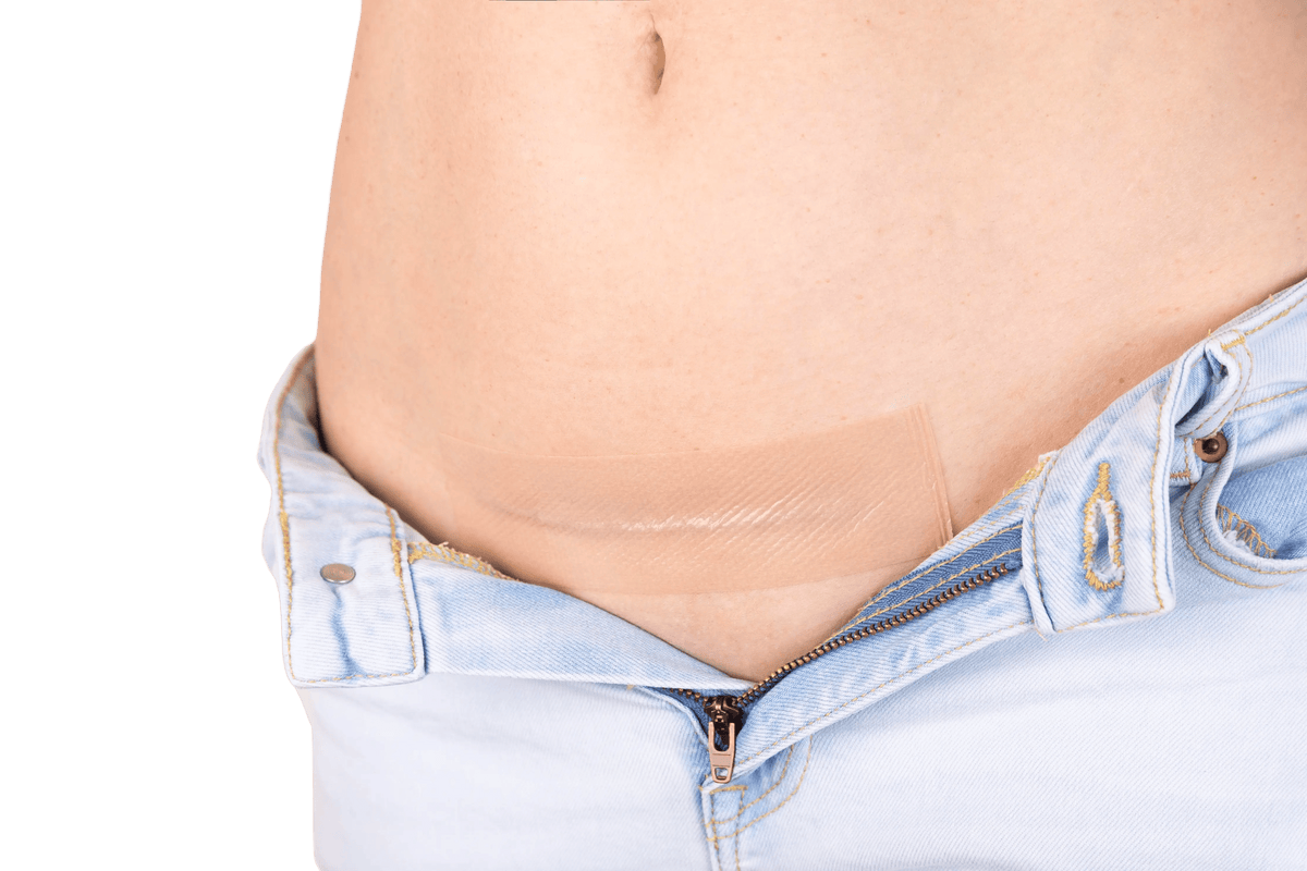Dermaclara C-Section Patch Dermaclara